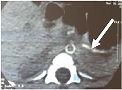 Case Report: A Novel Genetic Mutation Causes Idiopathic Infantile Arterial Calcification in Preterm Infants